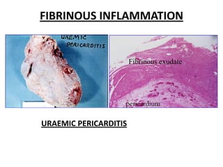 FIBRINOUS INFLAMMATION


                       Fibrinous exudate




                   pericardium

URAEMIC PERICARDITIS
 