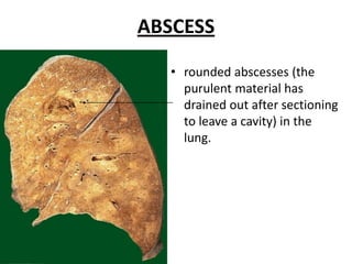 ABSCESS

   • rounded abscesses (the
     purulent material has
     drained out after sectioning
     to leave a cavity) in the
     lung.
 