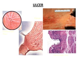ULCER


               Gross




Gastroscopic
View




                       Microscopic view
 