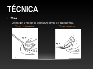 TÉCNICA
• TOMA
Definida por la relación de la curvatura pélvica y el occipucio fetal.
Toma no invertida Toma Invertida
 