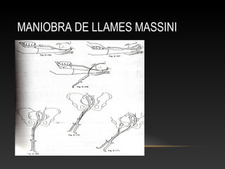 MANIOBRA DE LLAMES MASSINI
 