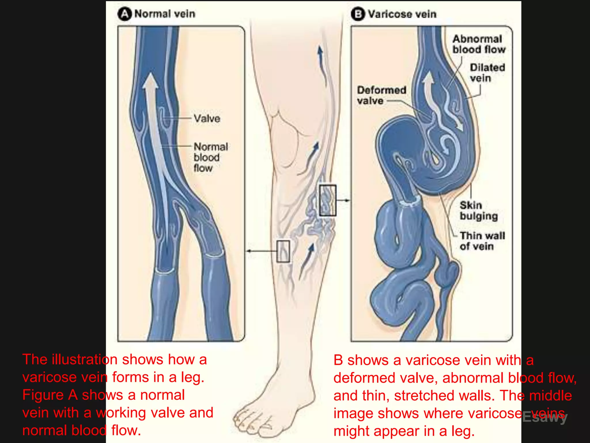 4 peripheral venous duplex pt 4 varices dr ahmed esawy | PPTX
