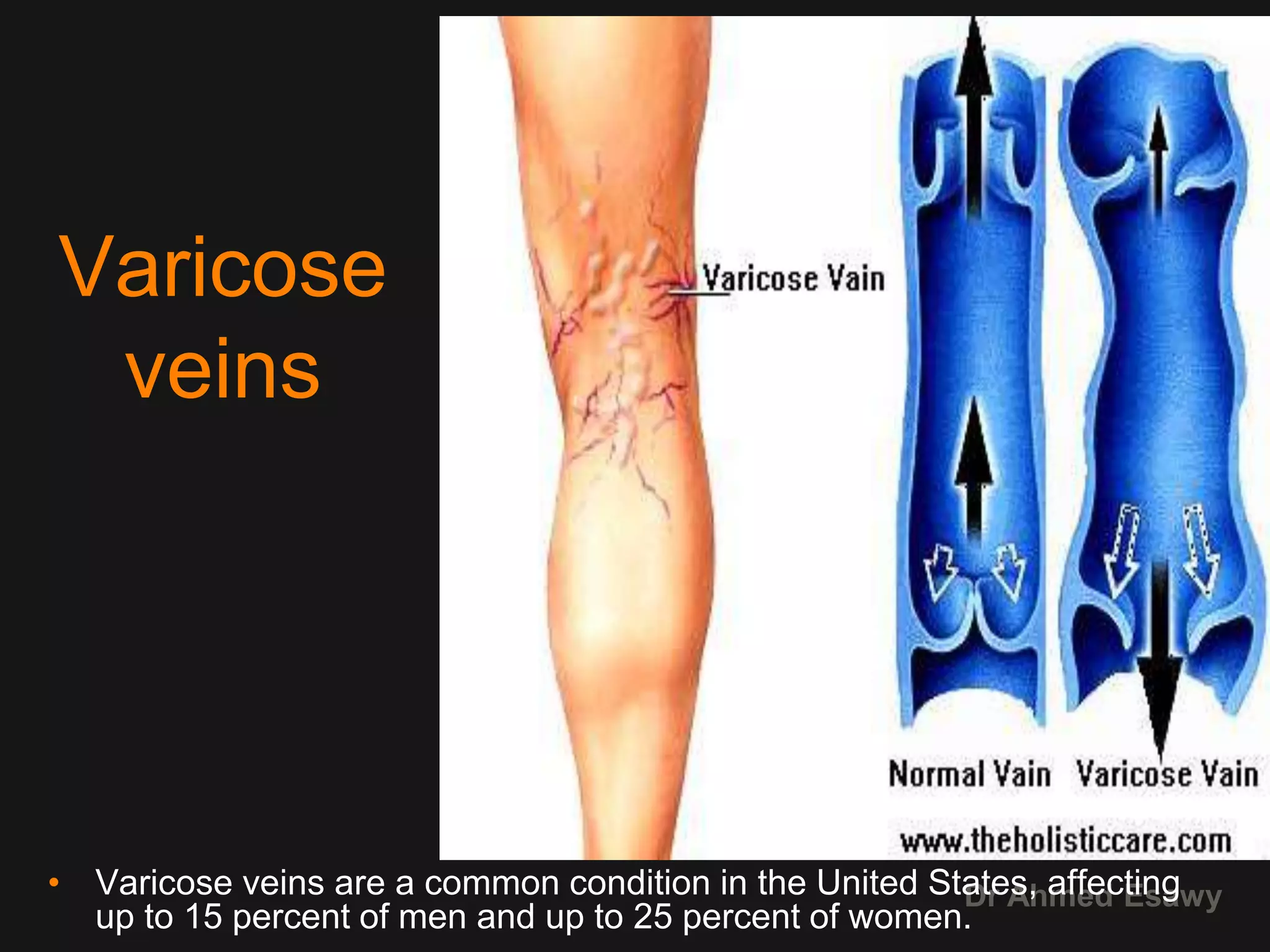 4 peripheral venous duplex pt 4 varices dr ahmed esawy | PPTX