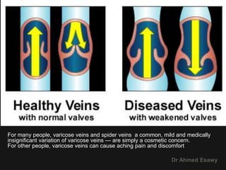 4 peripheral venous duplex pt 4 varices dr ahmed esawy | PPTX