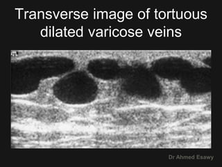 4 peripheral venous duplex pt 4 varices dr ahmed esawy | PPTX