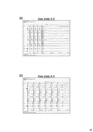 Electrophysiologic Study for Pacemaker Implantation | PDF