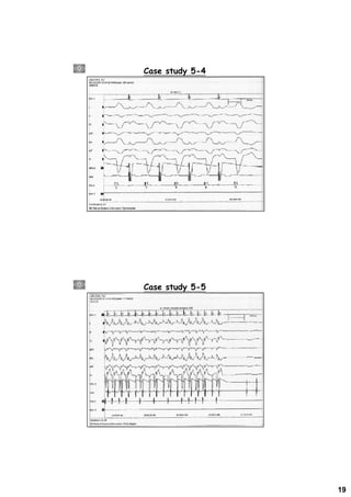 Electrophysiologic Study for Pacemaker Implantation | PDF