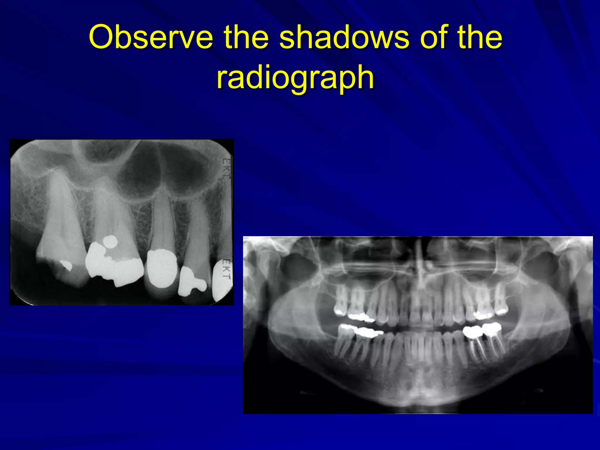 Observe the shadows of the
radiograph
 