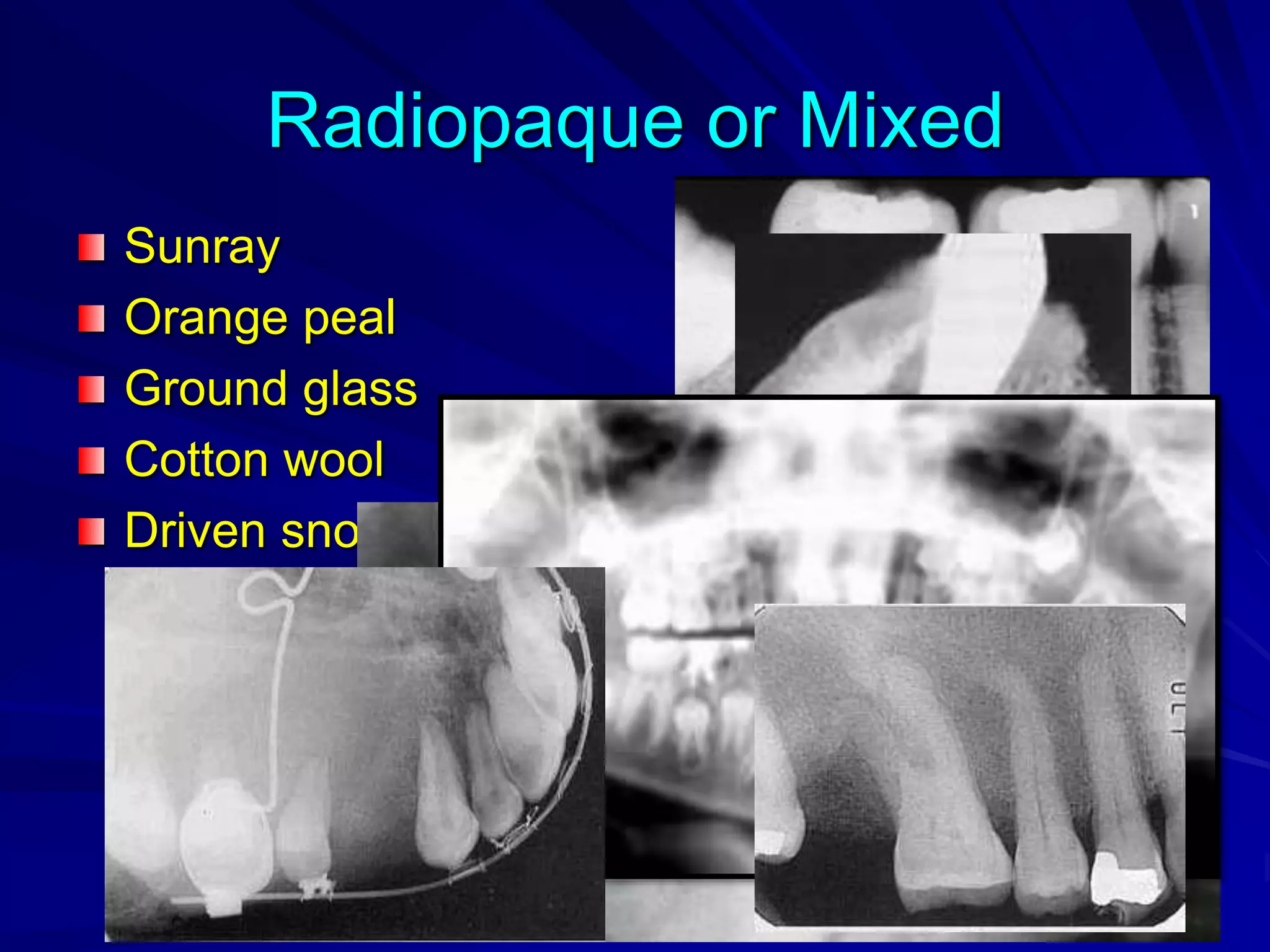 Radiopaque or Mixed
Sunray
Orange peal
Ground glass
Cotton wool
Driven snow
 