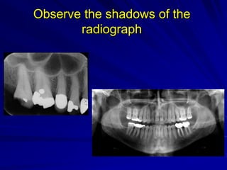 Observe the shadows of the
radiograph
 