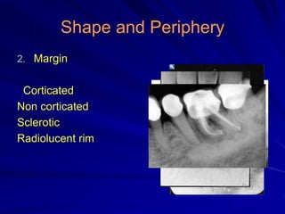 Shape and Periphery
2. Margin
Corticated
Non corticated
Sclerotic
Radiolucent rim
 