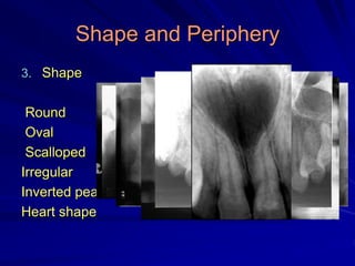 Shape and Periphery
3. Shape
Round
Oval
Scalloped
Irregular
Inverted pear
Heart shape
 