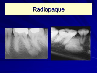 Radiopaque
 