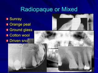 Radiopaque or Mixed
Sunray
Orange peal
Ground glass
Cotton wool
Driven snow
 