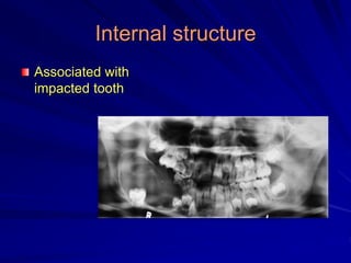 Internal structure
Associated with
impacted tooth
 