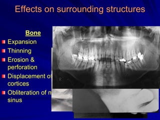 Effects on surrounding structures
Bone
Expansion
Thinning
Erosion &
perforation
Displacement of
cortices
Obliteration of max.
sinus
 