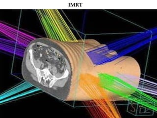 IMRT 