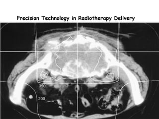 Precision Technology in Radiotherapy Delivery  