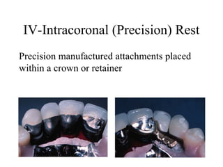 IV-Intracoronal (Precision) Rest
Precision manufactured attachments placed
within a crown or retainer
 