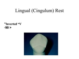 Lingual (Cingulum) Rest
Inverted “VInverted “V””
>>9090◦◦
 