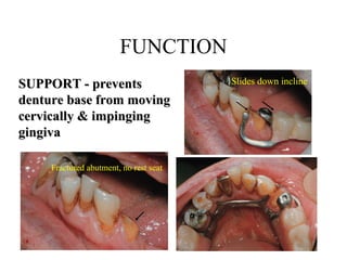 FUNCTION
Fractured abutment, no rest seat
Slides down inclineSUPPORT - preventsSUPPORT - prevents
denture base from movingdenture base from moving
cervically & impingingcervically & impinging
gingivagingiva
 