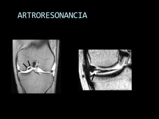 ARTRORESONANCIA
 