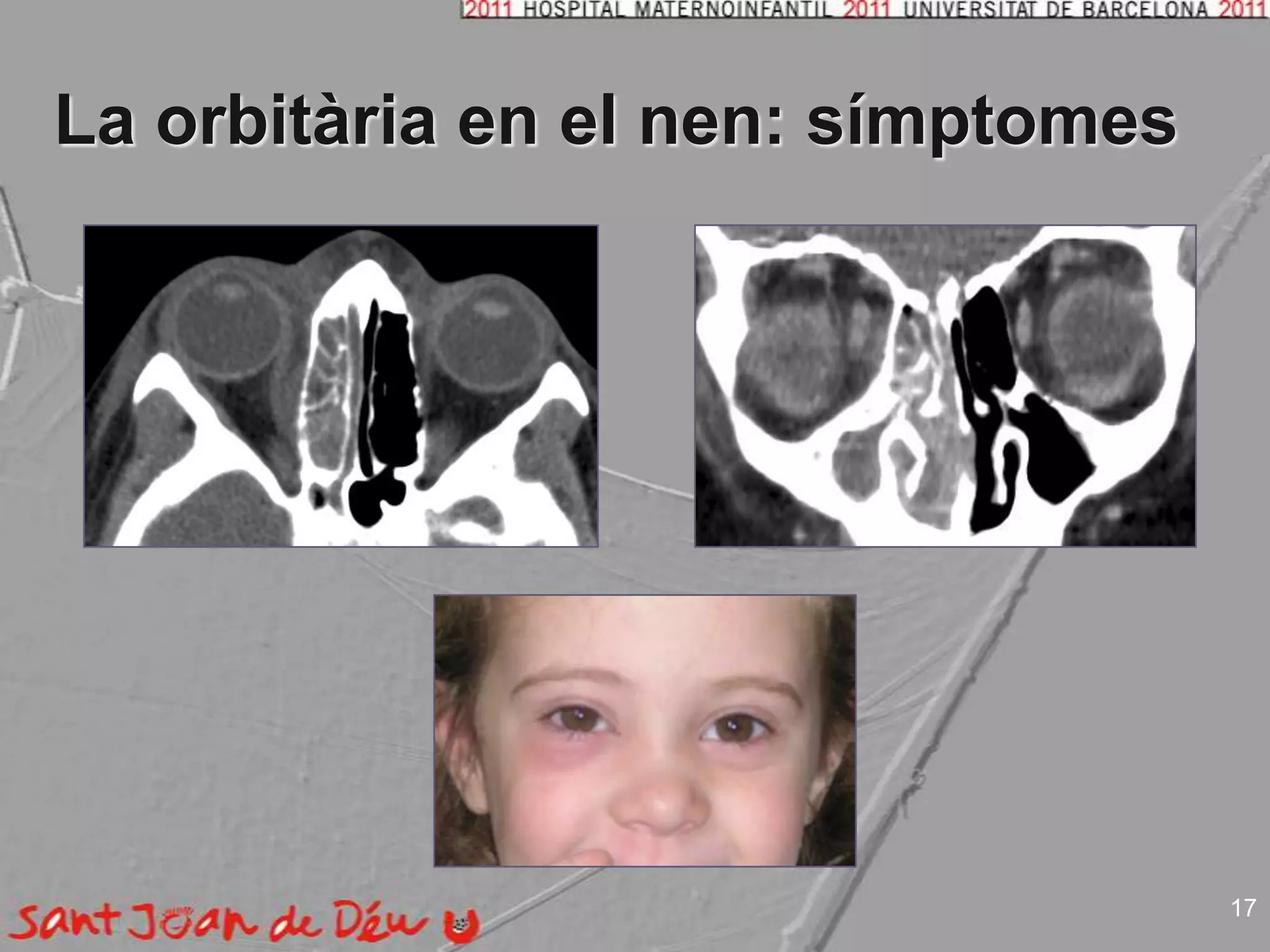 La orbitària en el nen: símptomes17