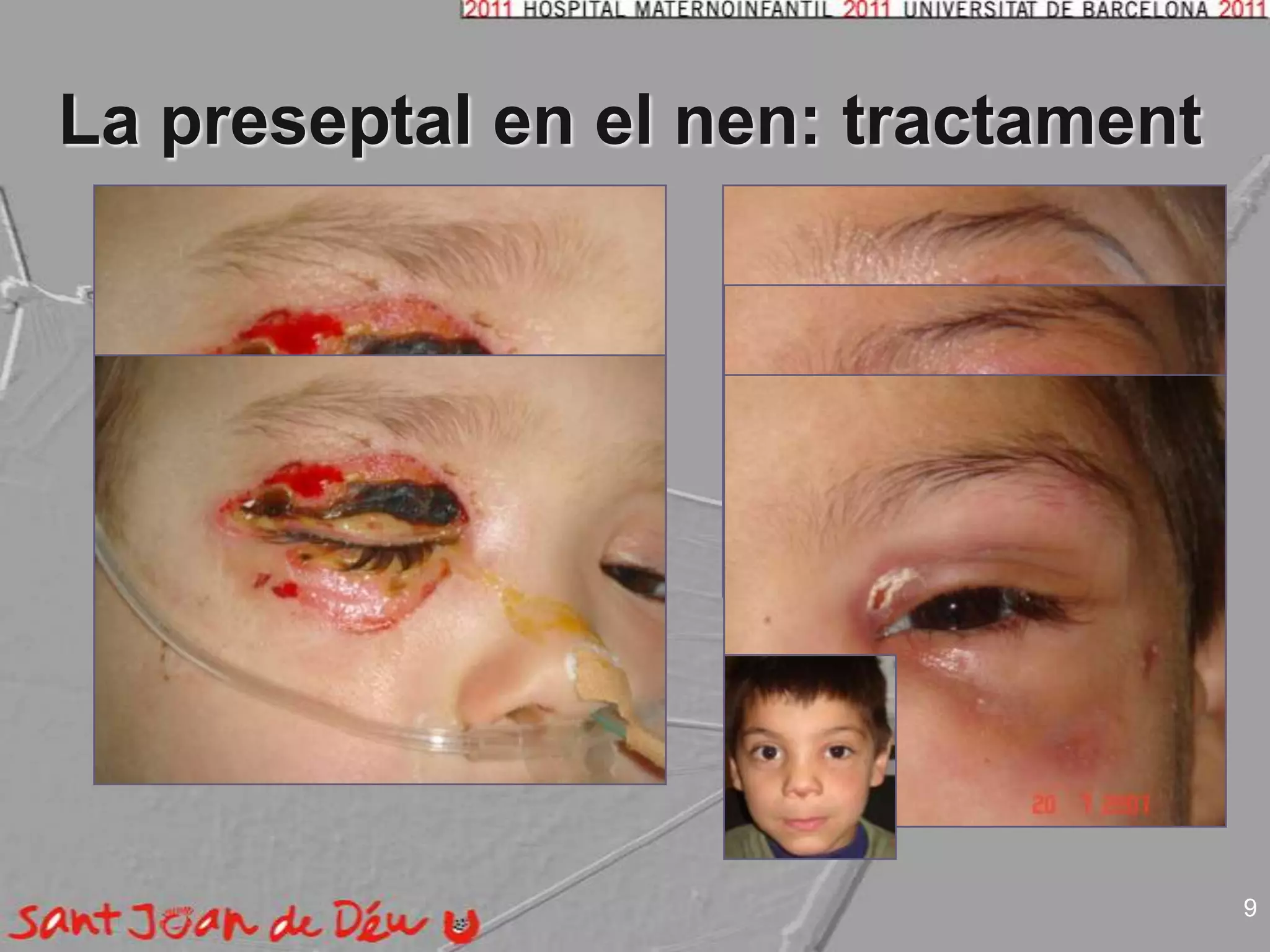 La preseptal en el nen: tractament9