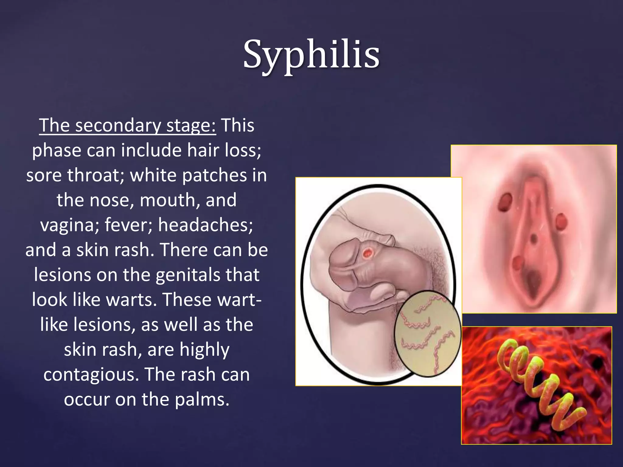 Syphilis
The secondary stage: This
phase can include hair loss;
sore throat; white patches in
the nose, mouth, and
vagina; fever; headaches;
and a skin rash. There can be
lesions on the genitals that
look like warts. These wart-
like lesions, as well as the
skin rash, are highly
contagious. The rash can
occur on the palms.
 