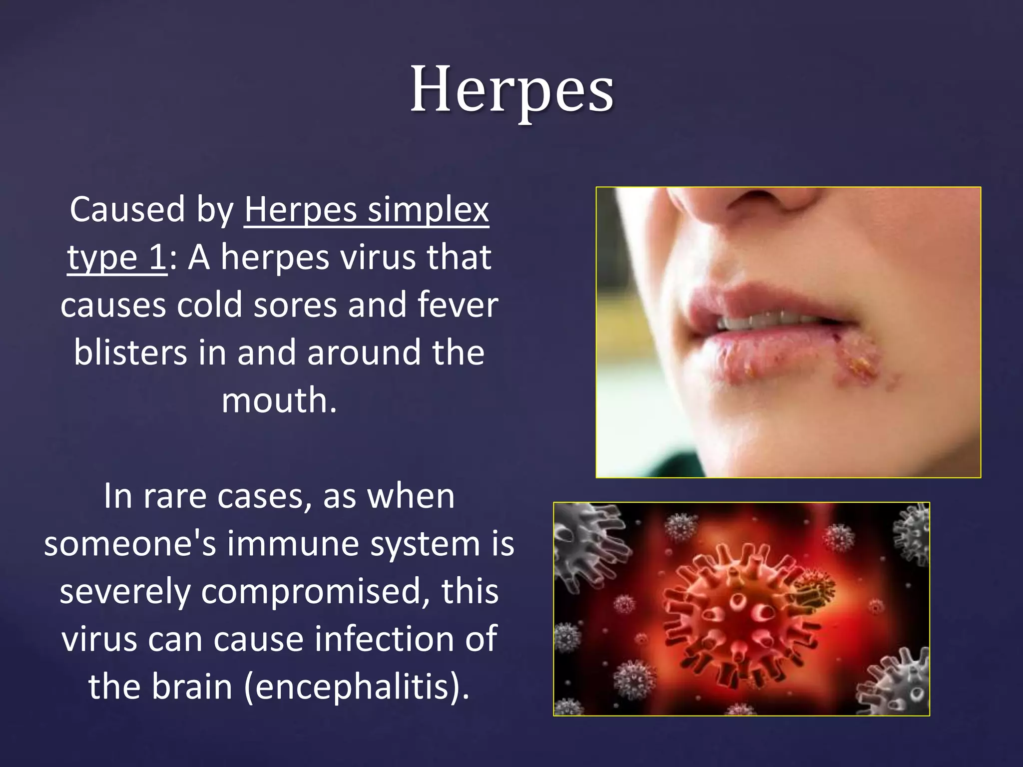 Herpes
Caused by Herpes simplex
type 1: A herpes virus that
causes cold sores and fever
blisters in and around the
mouth.
In rare cases, as when
someone's immune system is
severely compromised, this
virus can cause infection of
the brain (encephalitis).
 