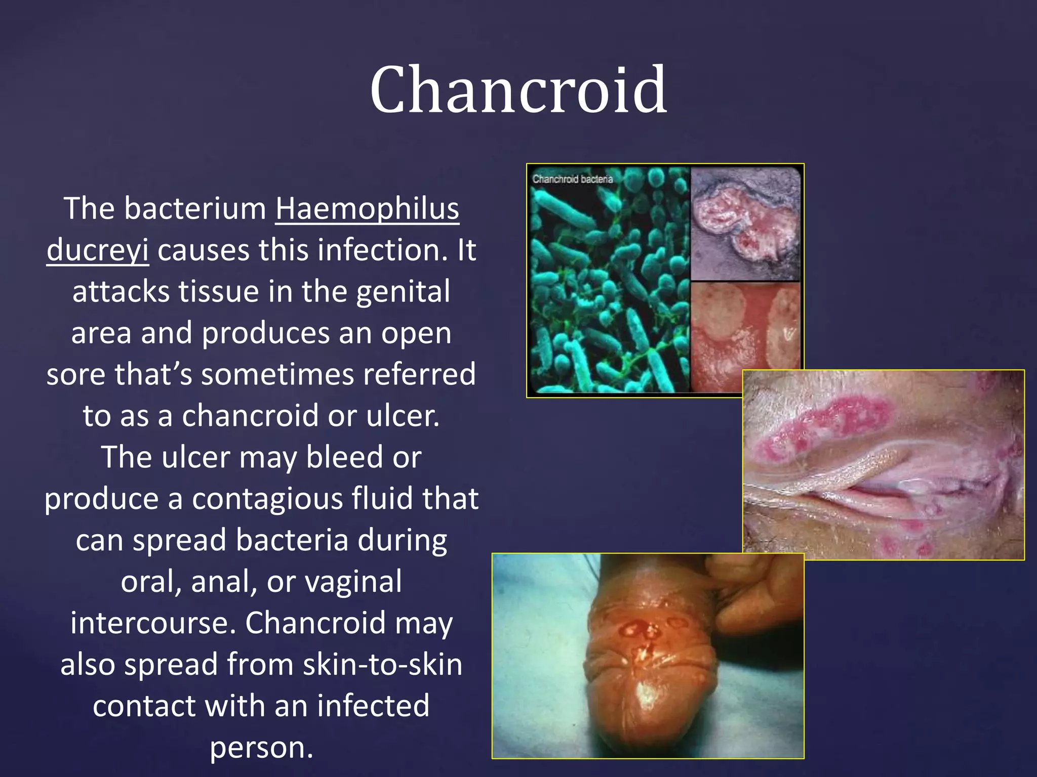 Chancroid
The bacterium Haemophilus
ducreyi causes this infection. It
attacks tissue in the genital
area and produces an open
sore that’s sometimes referred
to as a chancroid or ulcer.
The ulcer may bleed or
produce a contagious fluid that
can spread bacteria during
oral, anal, or vaginal
intercourse. Chancroid may
also spread from skin-to-skin
contact with an infected
person.
 