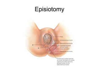 Episiotomy 