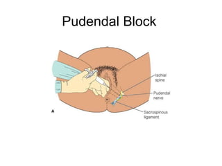 Pudendal Block 