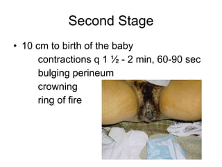 Second Stage 10 cm to birth of the baby contractions q 1 ½ - 2 min, 60-90 sec bulging perineum crowning ring of fire 