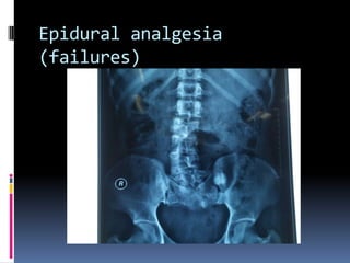Epidural analgesia
(failures)

 