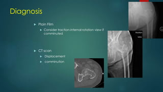  Plain Film
 Consider traction-internal rotation view if
comminuted
 CT scan
 Displacement
 comminution
Diagnosis
 