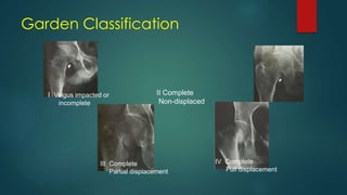 Garden Classification
I Valgus impacted or
incomplete
II Complete
Non-displaced
III Complete
Partial displacement
IV Complete
Full displacement
 