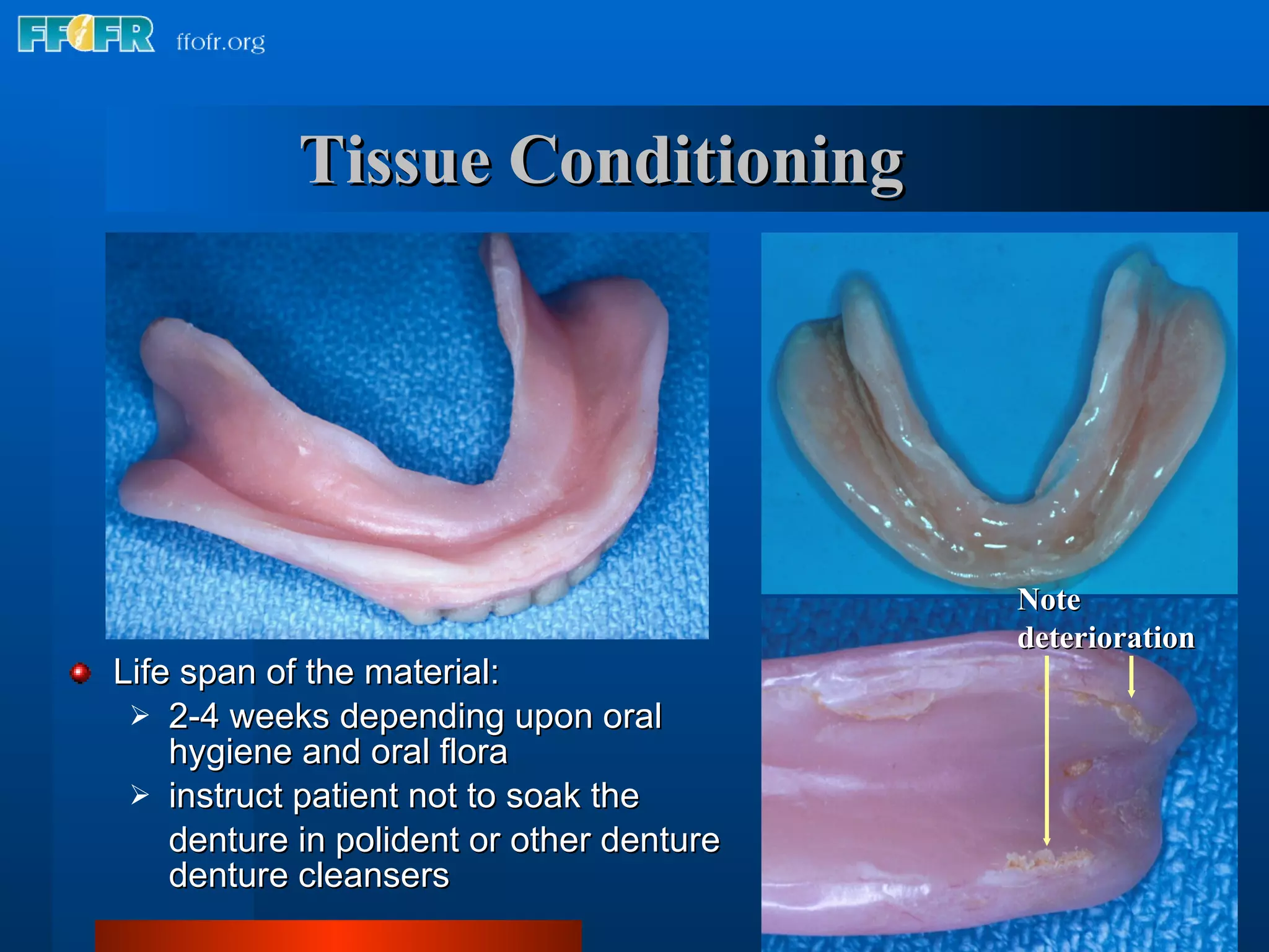 Tissue Conditioning   Life span of the material: 2-4 weeks depending upon oral hygiene and oral flora instruct patient not to soak the  denture in polident or other denture denture cleansers Note  deterioration 