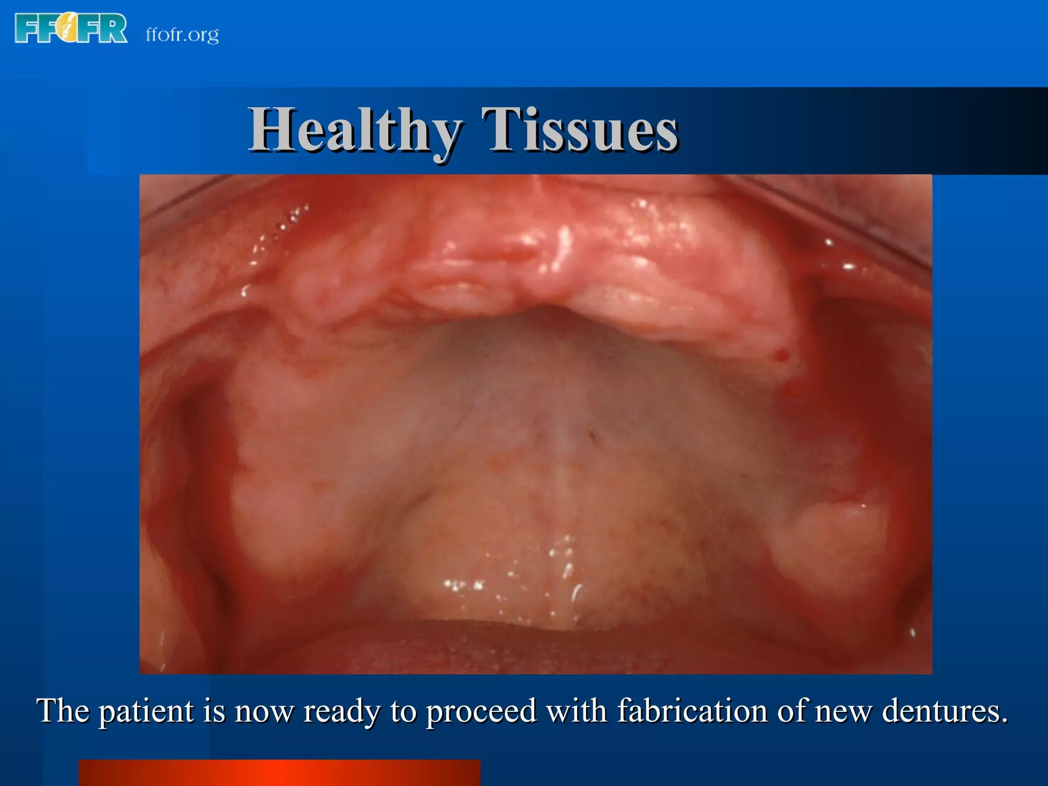 Healthy Tissues The patient is now ready to proceed with fabrication of new dentures. 