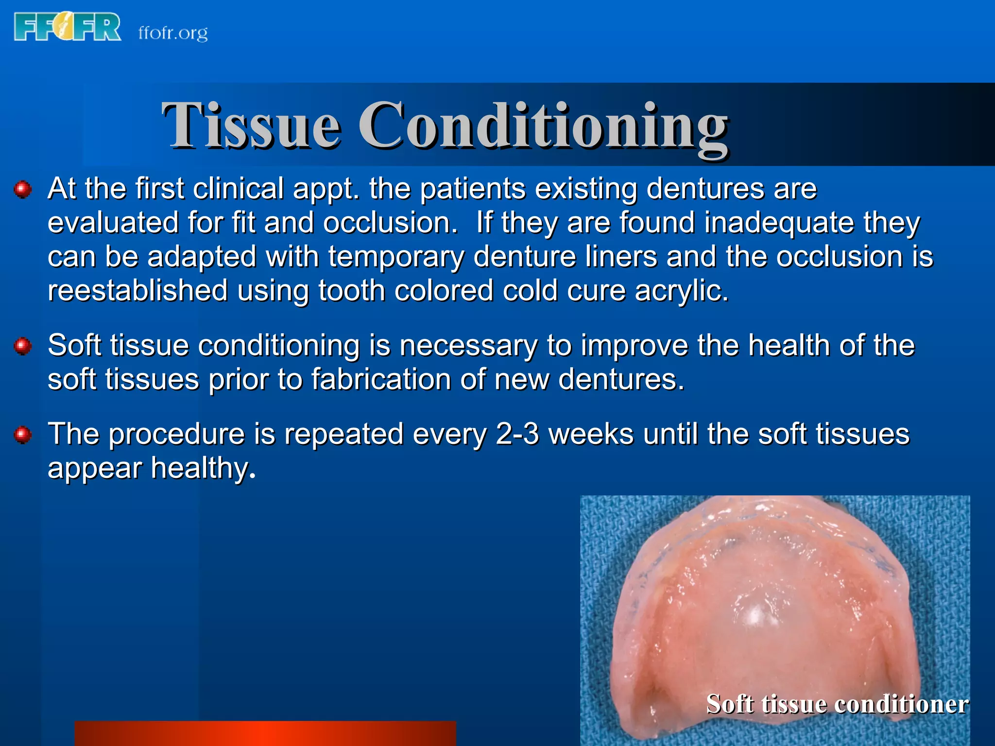 At the first clinical appt. the patients existing dentures are evaluated for fit and occlusion.  If they are found inadequate they can be adapted with temporary denture liners and the occlusion is reestablished using tooth colored cold cure acrylic. Soft tissue conditioning is necessary to improve the health of the soft tissues prior to fabrication of new dentures. The procedure is repeated every 2-3 weeks until the soft tissues appear healthy . Soft tissue conditioner Tissue Conditioning 