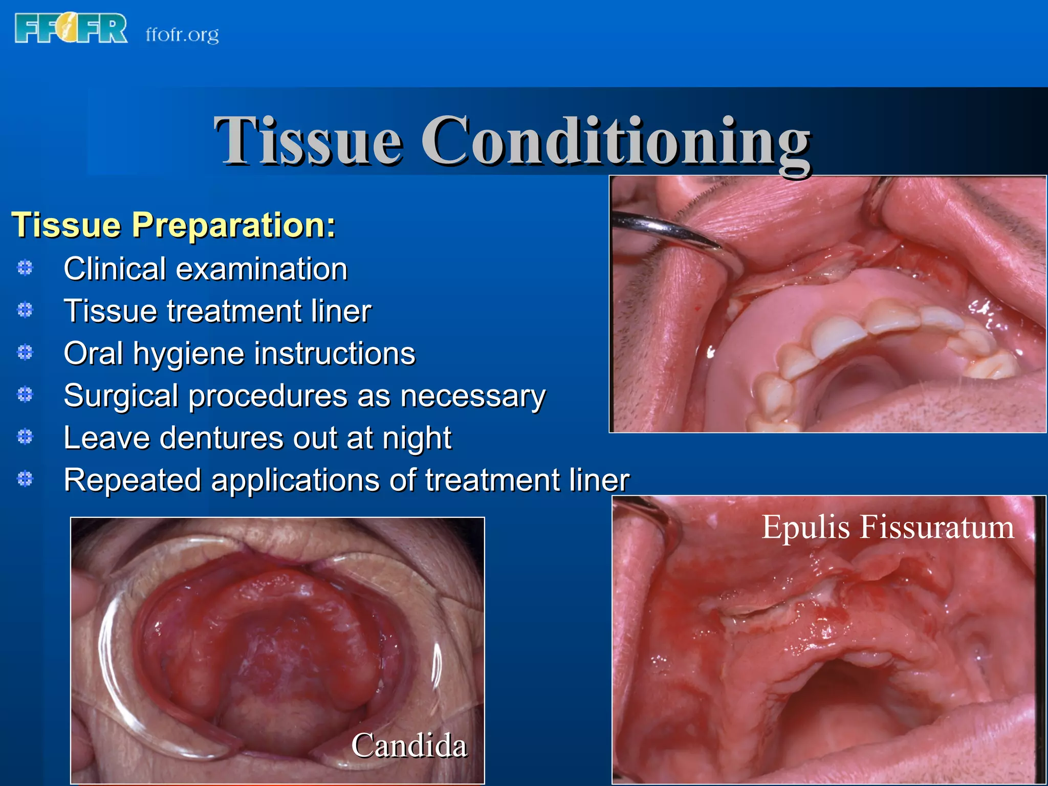 Tissue Preparation: Clinical examination Tissue treatment liner Oral hygiene instructions Surgical procedures as necessary Leave dentures out at night Repeated applications of treatment liner  Epulis Fissuratum Candida Tissue Conditioning 