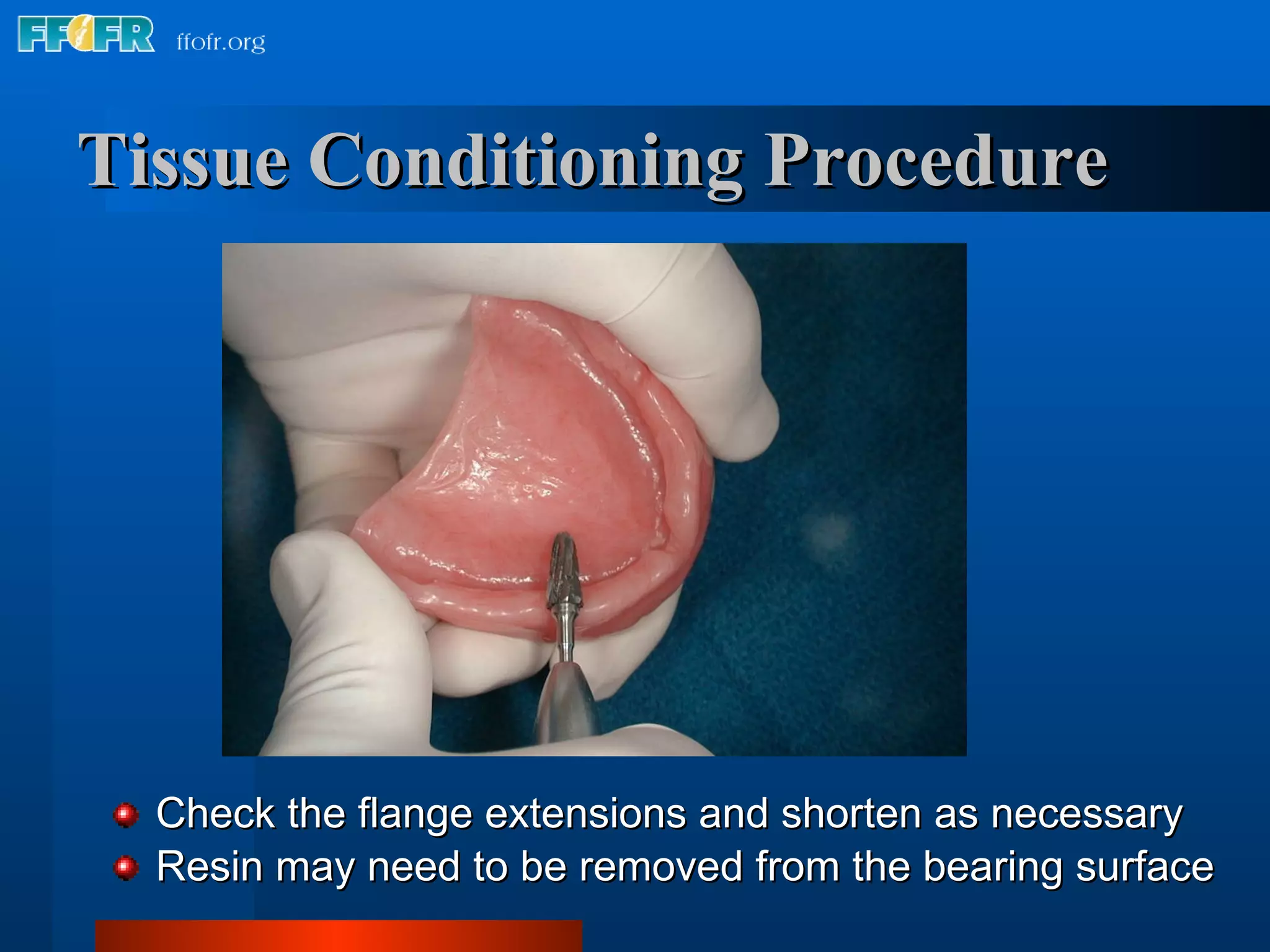 Tissue Conditioning Procedure Check the flange extensions and shorten as necessary Resin may need to be removed from the bearing surface 