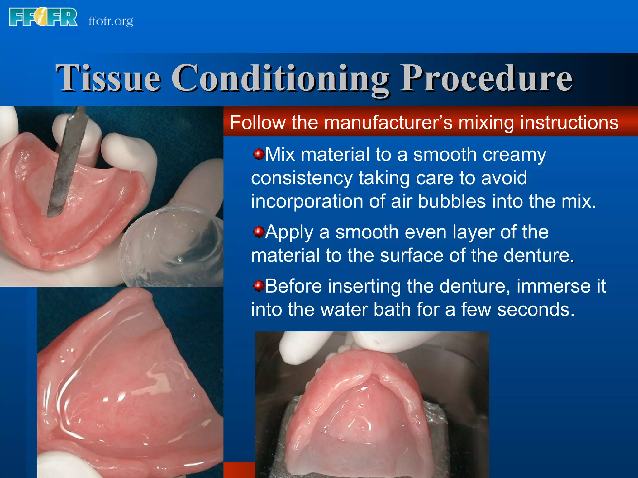 Tissue Conditioning Procedure   Mix material to a smooth creamy consistency taking care to avoid incorporation of air bubbles into the mix. Apply a smooth even layer of the material to the surface of the denture . Before inserting the denture, immerse it into the water bath for a few seconds. Follow the manufacturer’s mixing instructions 