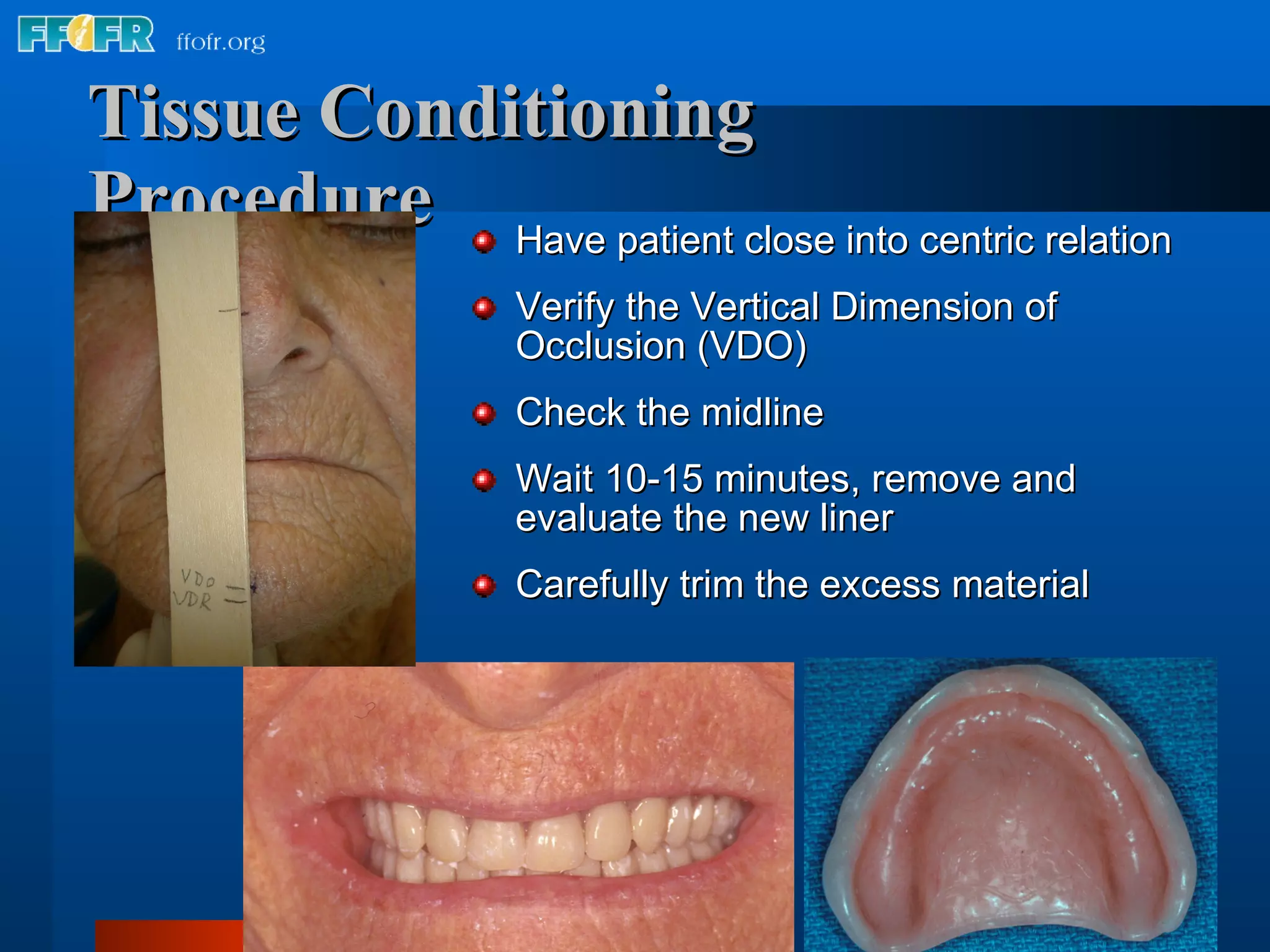Tissue Conditioning   Procedure Have patient close into centric relation Verify the Vertical Dimension of Occlusion (VDO) Check the midline Wait 10-15 minutes, remove and evaluate the new liner Carefully trim the excess material 