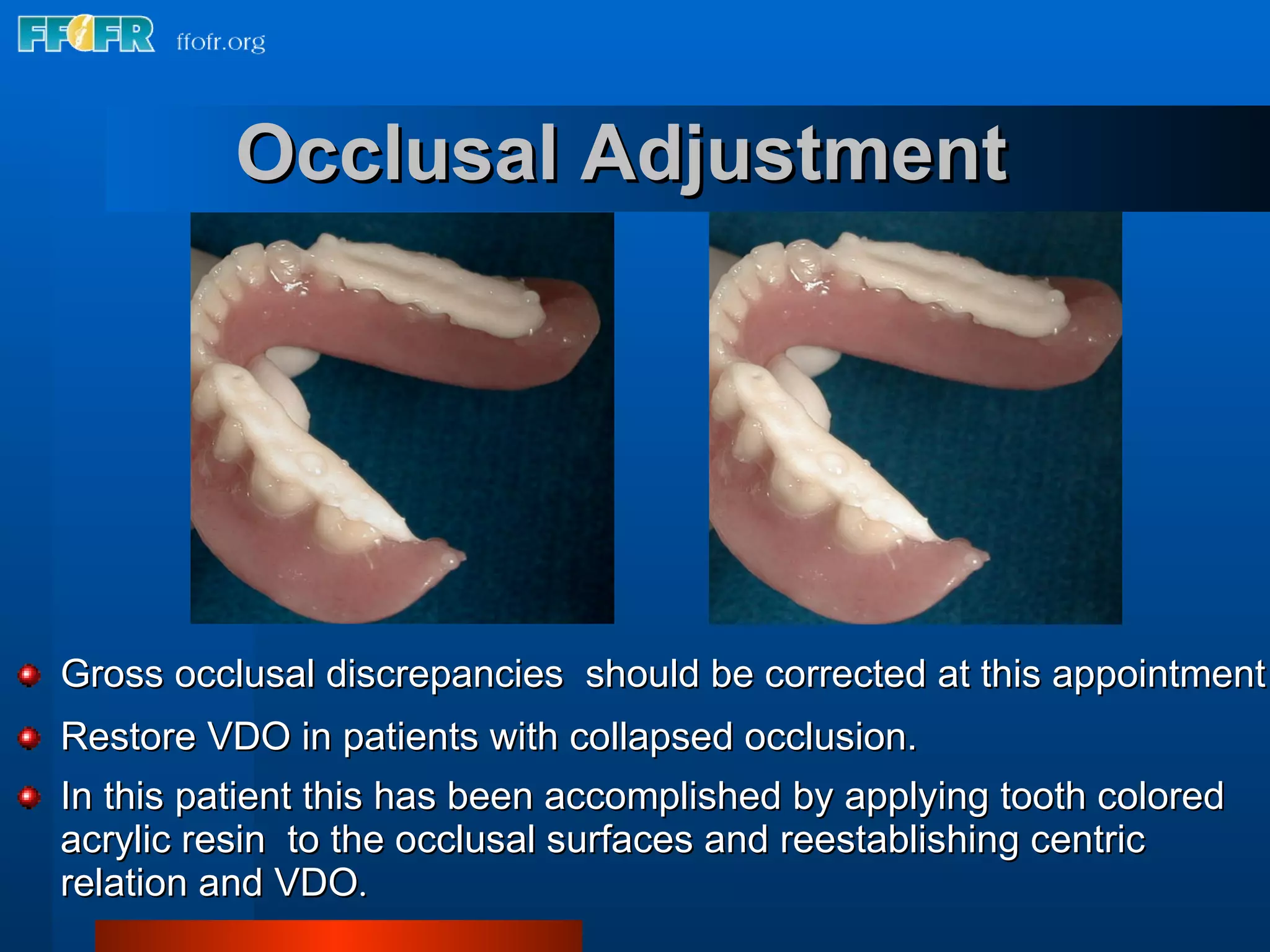 Gross occlusal discrepancies  should be corrected at this appointment Restore VDO in patients with collapsed occlusion. In this patient this has been accomplished by applying tooth colored  acrylic resin  to the occlusal surfaces and reestablishing centric relation and VDO .  Occlusal Adjustment 