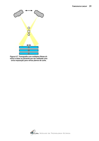 TOMOGRAFIA LINEAR   31




Figura 4.7. Tomografia com múltiplos filmes di-
minui a dose no paciente por ser realizada uma
 única exposição para vários planos de corte.




                                     Núcleo de Tecnologia Clínica
 