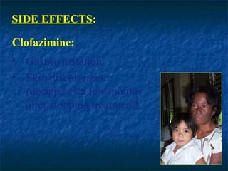SIDE EFFECTS:

Clofazimine:
• Gastric irritation.
• Skin discoloration
  (disappears a few months
  after stopping treatment).
 