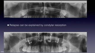 Treatment planning of surgical orthodontic cases dgkfo | PDF
