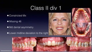 Treatment planning of surgical orthodontic cases dgkfo | PDF