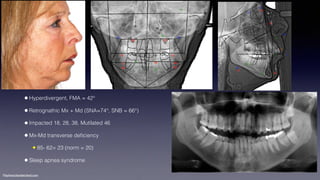 Treatment planning of surgical orthodontic cases dgkfo | PDF